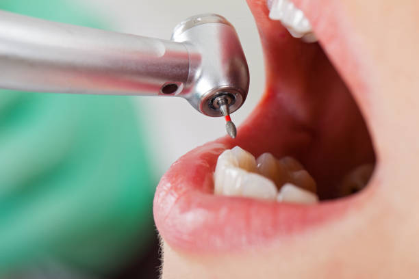 Best Knocked-Out Tooth (Avulsed Tooth) Treatment in Ellaville, GA
